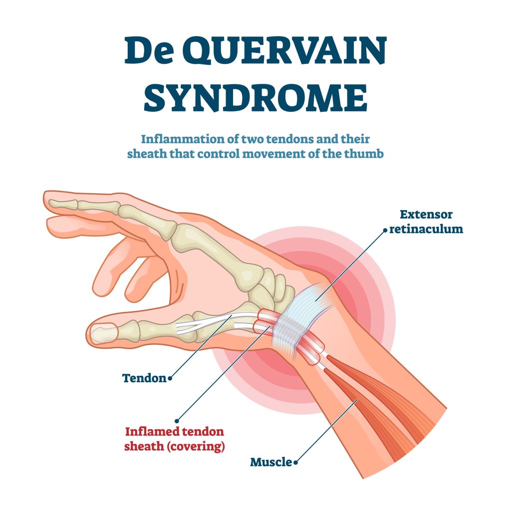 Dealing with "New Parent’s Thumb"? Understanding De Quervain’s Tenosynovitis 1 licensed image Expert Orthopaedic Care in Vadodara | Ortho Care Hospital