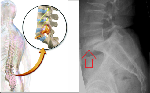 Spondylolisthesis Expert Orthopaedic Care in Vadodara | Ortho Care Hospital